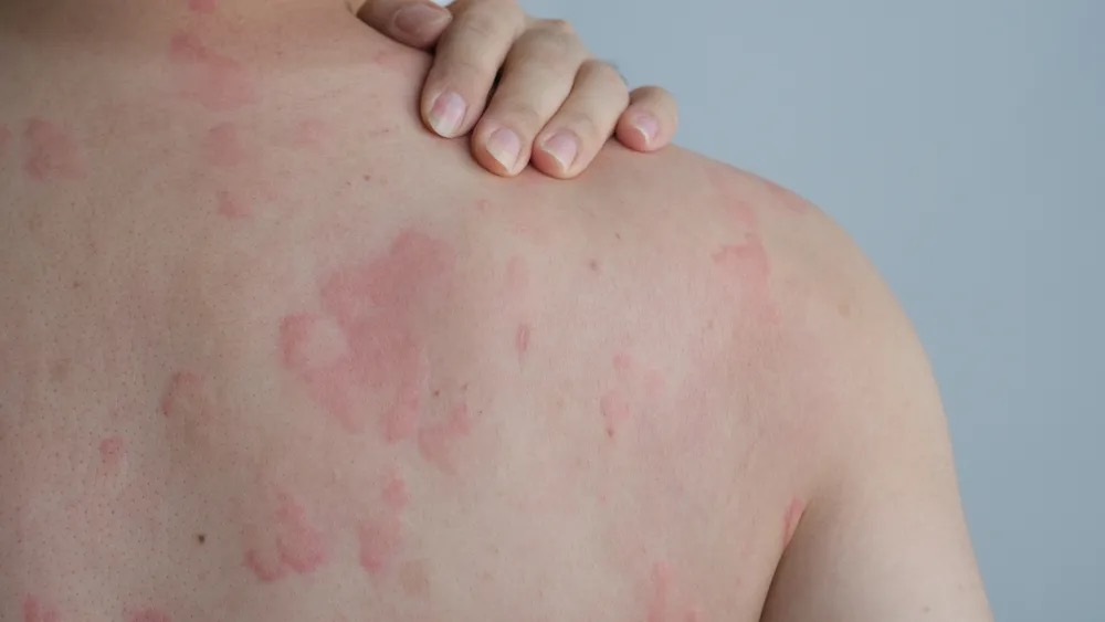 Close-up dermatology treatment results