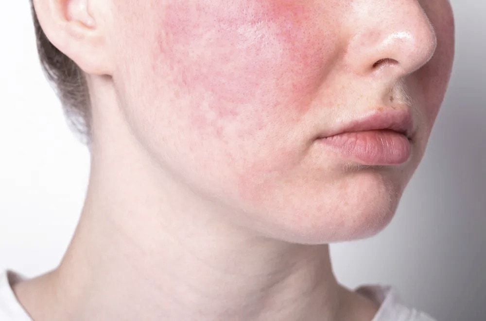 Young woman with visible facial rosacea symptoms