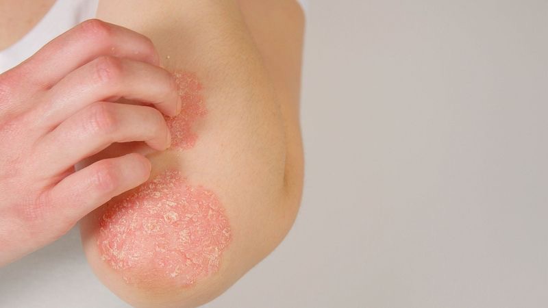 Psoriasis-related skin texture detail