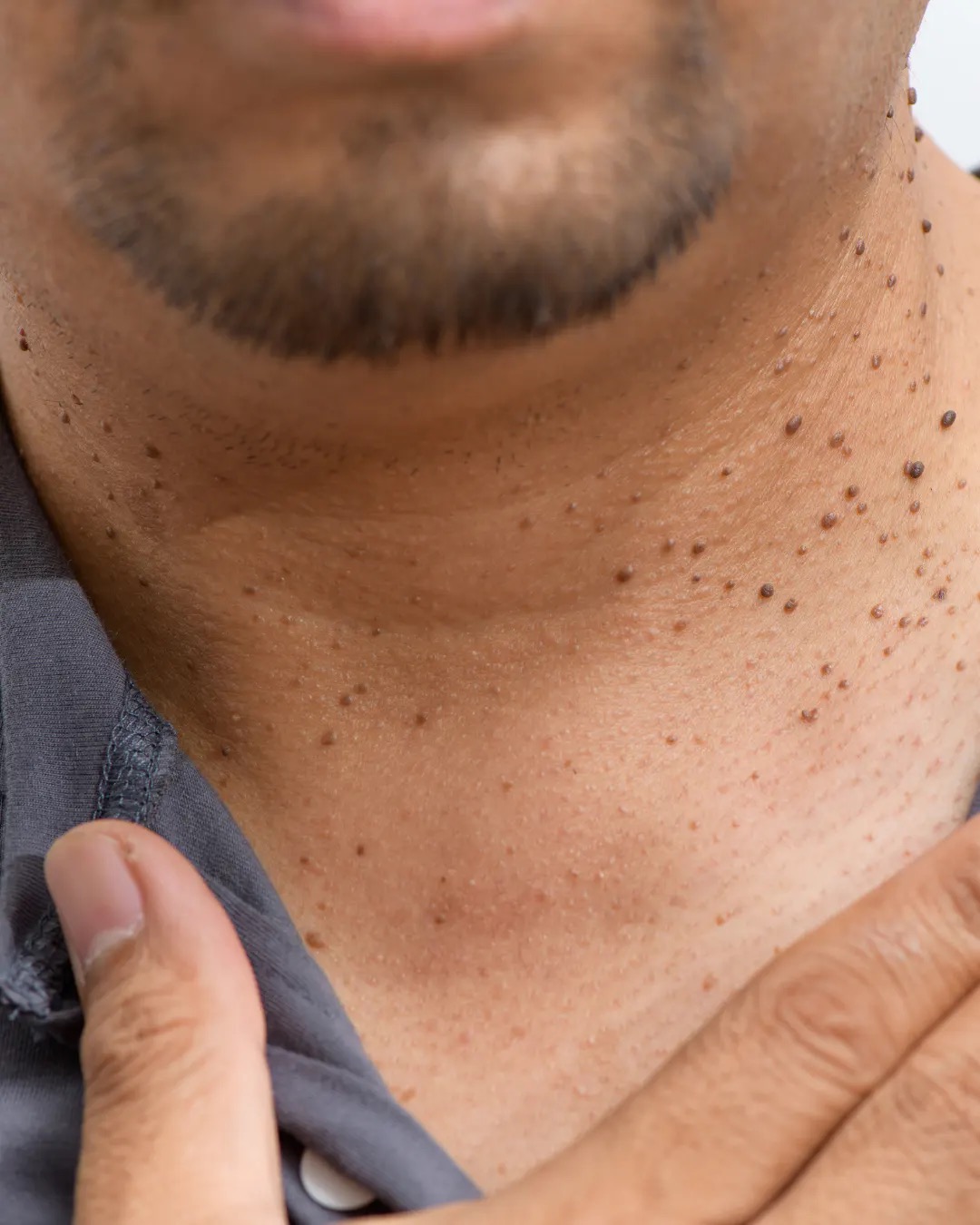 Close-up of neck skin concerns during dermatology evaluation
